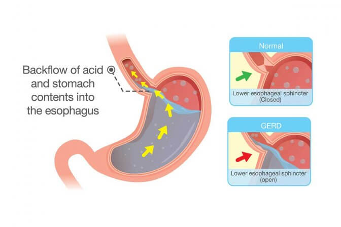 GERD: Symptoms, Causes, Prevention, Treatment - How to Treat Heartburn