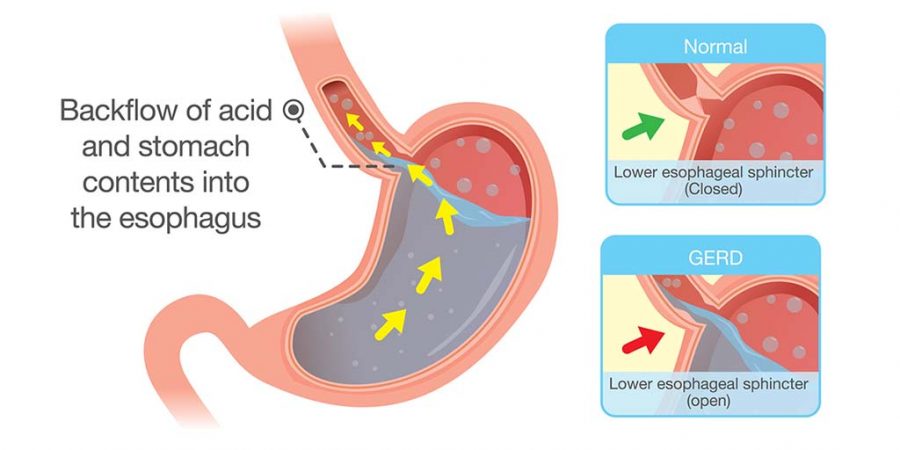 What is GERD? Gastroesophageal reflux disease (GERD) is the chronic occurrence of acid reflux. Heartburn is the most common symptom of GERD and is caused by the irritation of refluxed acid in the esophagus.
